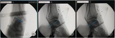 Comparative analysis of short-term efficacy between robot-assisted retrograde drilling and arthroscopic microfracture for osteochondral lesions of the talus